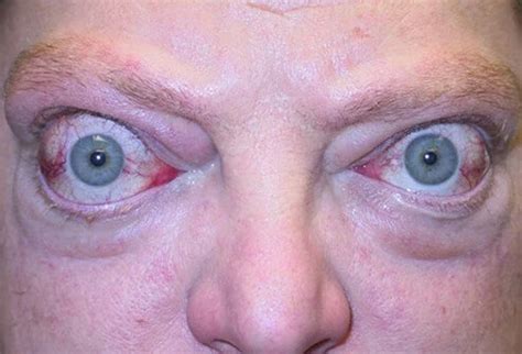 Eye graves disease - Definition of Eye graves disease