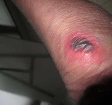 Key principles of pressure injury prevention - QSCIS