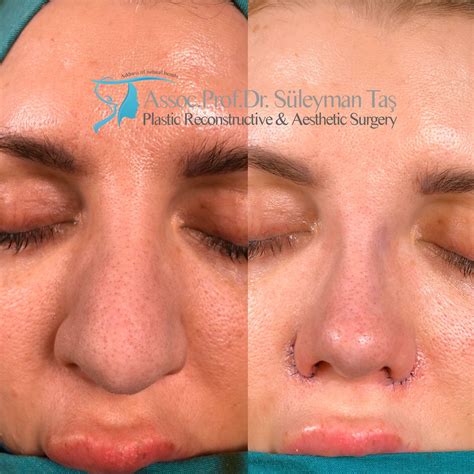 nose job plastik cerrahi evrim burun estetigi