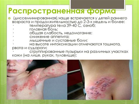 Герпес. Детская гинекология - презентация онлайн