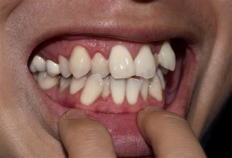 Genetic Factors Impacting Teeth Alignment | Ahava Orthodontics