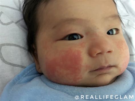 Facial Eczema Newborn at Eve Collie blog