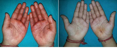 Figure 1 from Various Colors of Presentation of Pseudochromhidrosis - A ...