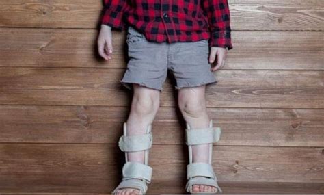 Osteomalacia : causes, symptoms and treatments - En.ImArabic