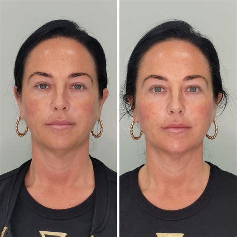 surgical face lift  surgical facelift treatment