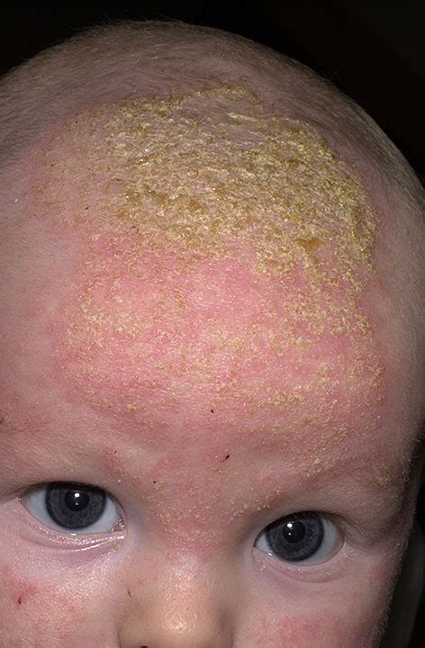 seborrheic dermatitis infant - pictures, photos