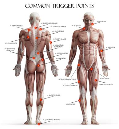Trigger Point Injections - Motion Is Medicine
