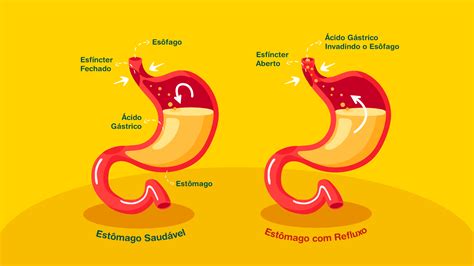 Como Funciona O Refluxo - Queimação e refluxo: origem, causa e tratamentos - Rotina da Saude