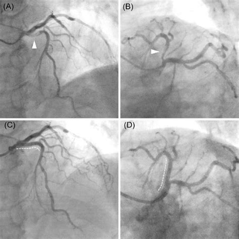 Figure3.Intravascular ultrasound (IVUS). (A) IVUS after aspiration ...