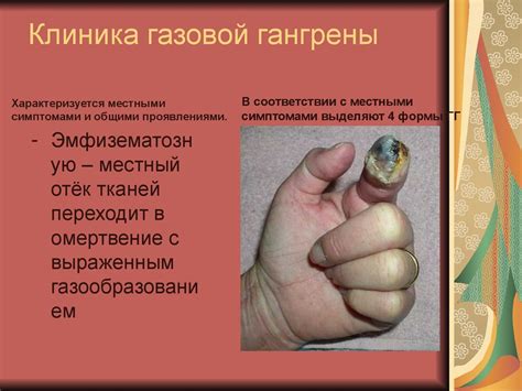 Сестринский процесс при газовой гангрене - online presentation