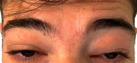 Upper Eyelid Infection