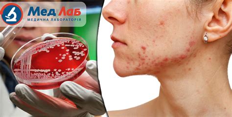 Золотистый стафилококк на коже рук фото