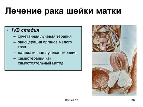 Рак шейки матки - презентация онлайн