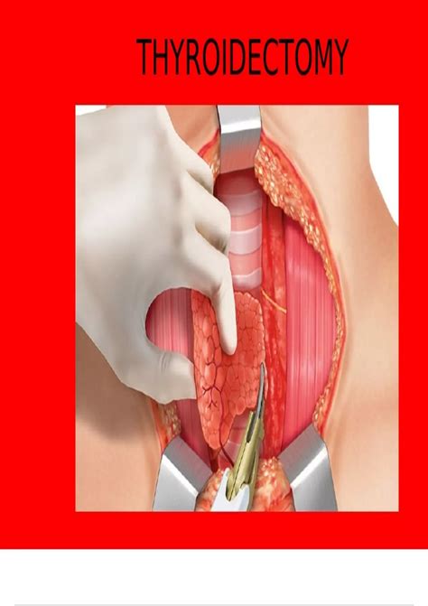 Summary Surgical Nursing-Thyroidectomy - Nursing - Stuvia US