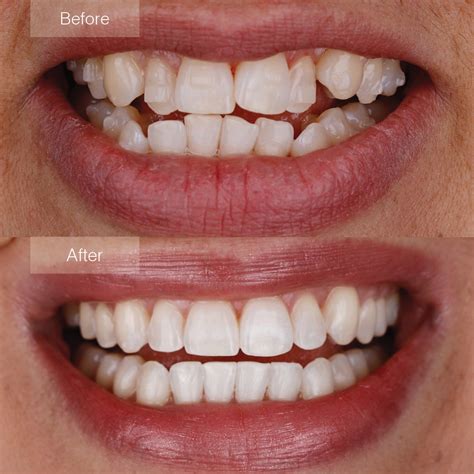 Invisalign Before and After - The Dental Room