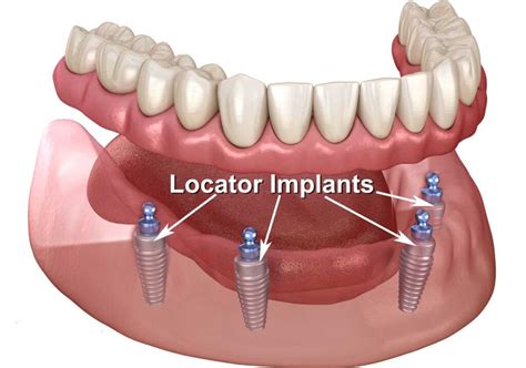 Snap On Dentures - Appearance Implant & Family Dentistry