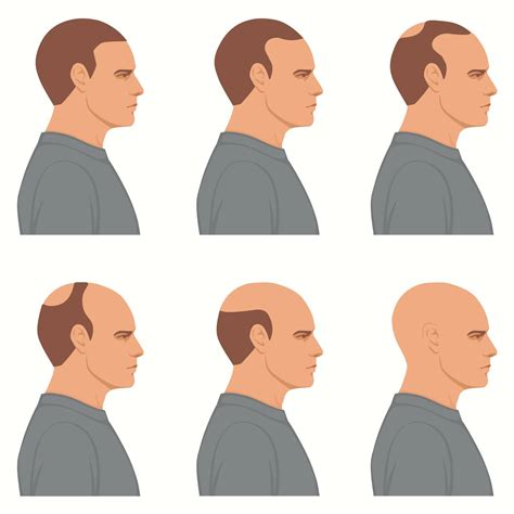 Hair styles for balding men can make you look younger 19