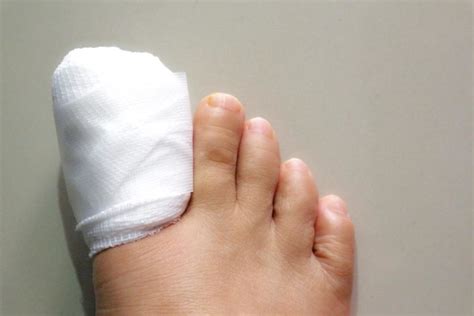 Unghie încarnată - Chirurgie Plastică | Chirurgia Mâinii | Chirurgie ...
