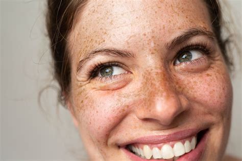 children  freckles heres   skin