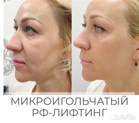Микроигольчатый РФ лифтинг в Санкт-Петербурге | Услуги | Авито