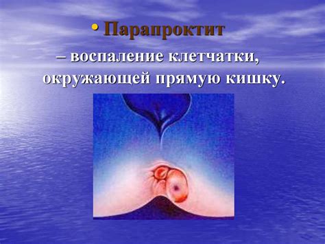 Заболевания прямой кишки - презентация онлайн