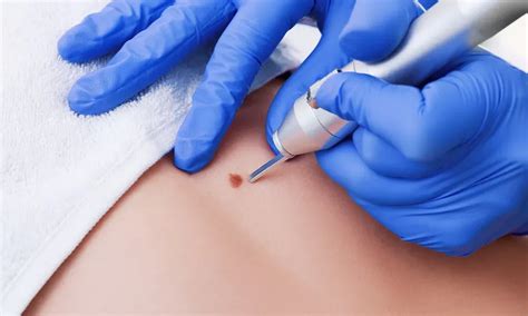 Skin Tag Removal for Miami, Homestead, Sarasota, Venice , Longboat Key ...