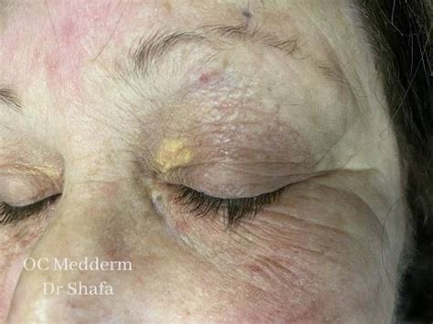 Xanthelasma Removal Irvine & Orange County | Dr. Parvin Shafa