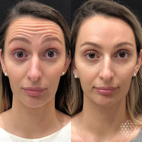Differences Between BBL Vs IPL Treatments | Skin Technique