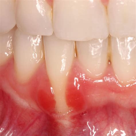 Gum graft healing stages | Highlands Ranch Periodontics