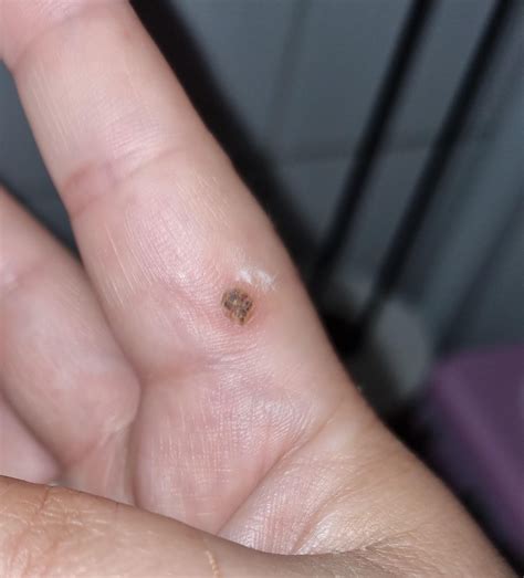 Is it gone? the scab fell off by I still feel a circular bump. could it
