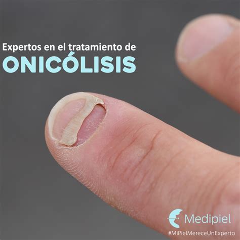 Medipiel - La Onicólisis es una enfermedad que causa que...