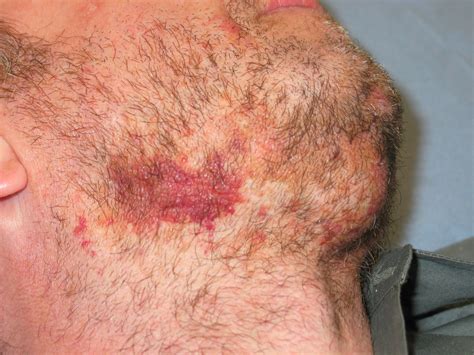 Amyloidosis Skin Changes