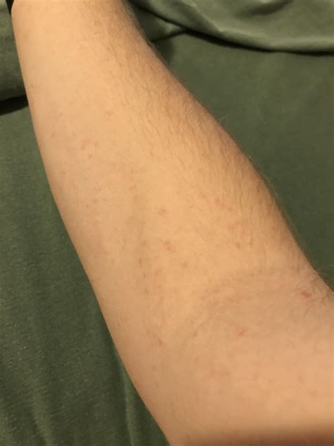 does kenalog injection work immediately 10