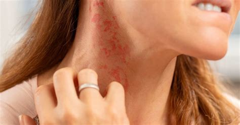 An Introduction To The Types Of Itchy Skin Rashes The - vrogue.co