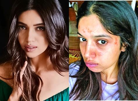 Bollywood Celebrity Acne Scars