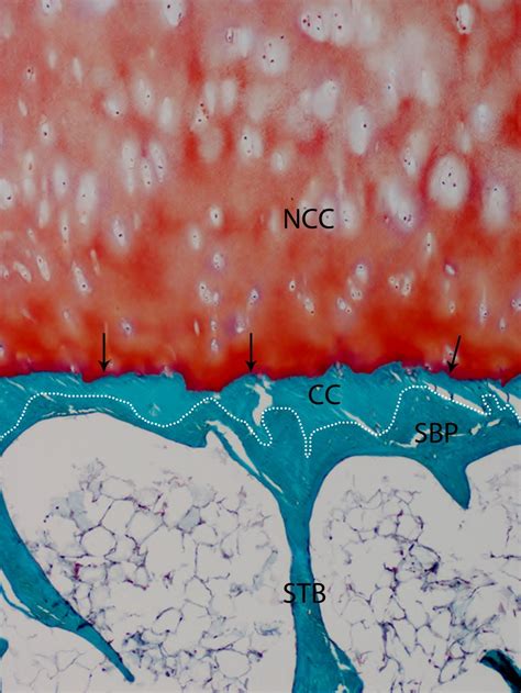 Subchondral bone in osteoarthritis: insight into risk factors and