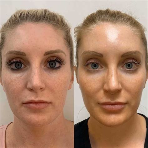 PRP Treatment for Face at Facial Rejuve - Facial Rejuve