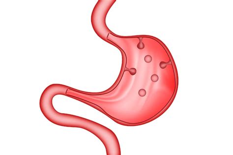 Premium Photo | Stomach polyps of the digestive system