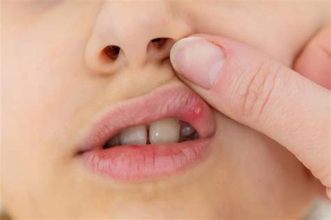 mouth ulcers  children symptoms signs balmain dentist