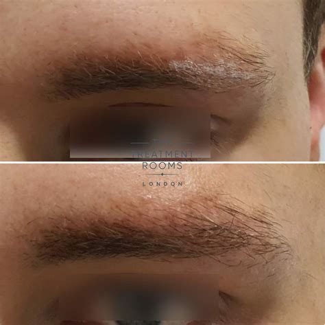 How Does An Eyebrow Hair Transplant Work? | Contact Us