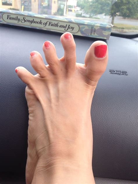 23 photos that reveal how ehlers danlos syndrome affects the skin – Artofit