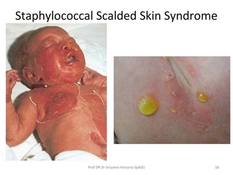 Steven johnson syndrome & ten | PPT
