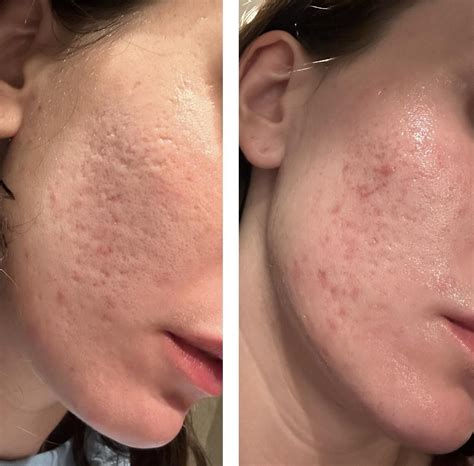 how to get tretinoin amazon reddit