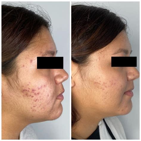 Procell Microchanneling - Elite Esthetics Gainesville FL