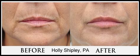 Lower Face Filler in Weston & Fort Lauderdale, FL