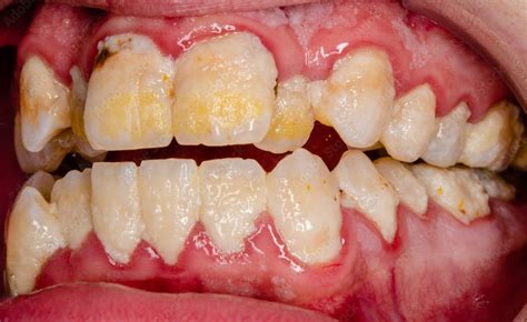 dental plaque 3 Object Detection Dataset by QY Zhang
