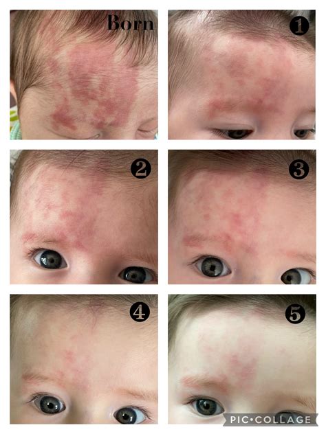 Port wine stain birthmark - cutsery