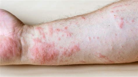 rash  common skin rashes pictures  treatment artofit