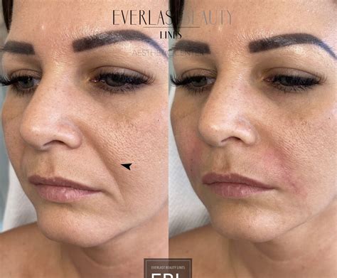 Wrinkle filling - EBL Aesthetic Center