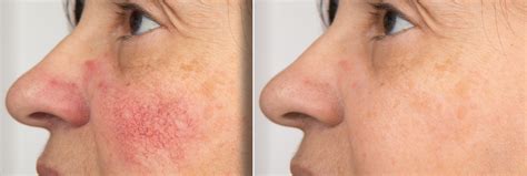 rosacea excellence medical skin care clinic